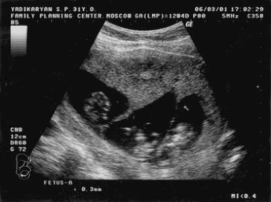 Беременность 10 Недель Двойня Фото