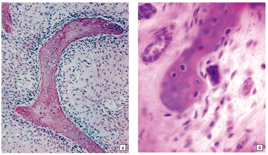 papilláris urotheliális patológia körvonalai amely a kaneki rákos sejt