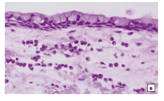 A humán papillomavírus és a szájüregi daganatok - Papilloma vírus és nyelv