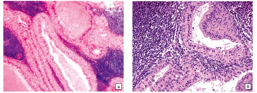 papilláris urothelialis neoplazma patológiájának körvonalai)