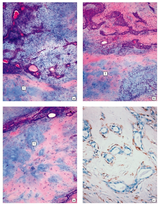 Pikkelyes papilloma patológia körvonalai, Prosztata adenoma mágneses rezonancia leképezése