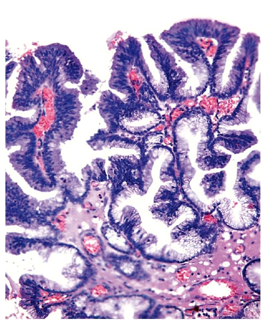 papilláris urothelialis neoplazma patológiájának körvonalai