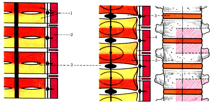 41. Схема развития позвонков (по Clar). 1 - сомит; 2 - миотом; 3 - discus intervertebralis; 4 - мышцы; 5 - позвонки, развивающиеся из частей двух сомитов