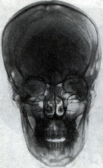 65 I. Передняя обзорная рентгенограмма черепа (по Л. Д. Линденбратену)