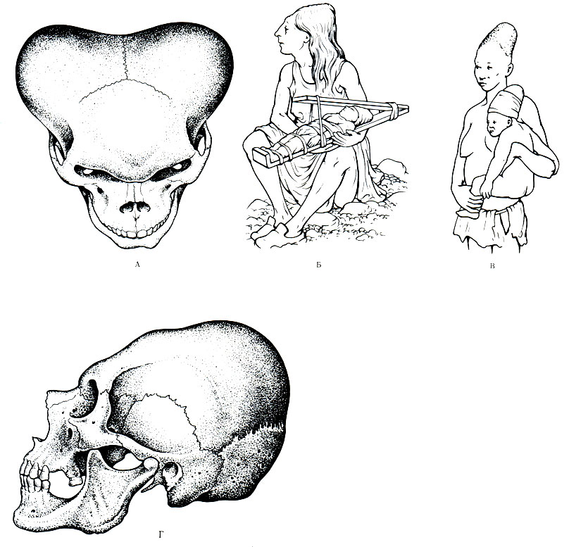 82. Искусственная деформация черепа. А - череп из до колумбийских могил в Перу; Б - индианка с ребенком; В - круговое бинтование головы; Г - череп, деформированный в результате бинтования