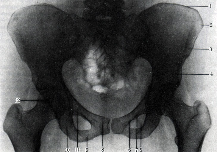 93. Рентгенограмма тазовых костей взрослого. 1 - подвздошный гребень; 2 - передняя верхняя подвздошная ость; 3 - передняя нижняя ость; 4 - пограничная линия; 5 - верхняя ветвь лобковой кости; 6 - нижняя ветвь лобковой кости; 7 - запирательное отверстие; 8 - лобковый бугорок; 9 - ветвь седалищной кости; 10 - седалищный бугор; 11 - ветвь седалищной кости; 12 - головка бедренной кости