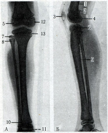 96. Задний (А) и левый (Б) снимки костей правой голени юноши. 1 - диафиз бедренной кости; 2 - метафиз бедренной кости; 3 - надколенник; 4 - ростковый хрящ; 5 - латеральный мыщелок бедренной кости; 6 - проксимальный эпифиз большеберцовой кости; 7 - проксимальный эпифиз малоберцовой кости; 8 - метафиз малоберцовой кости; 9 - диафиз мало берцовой кости; 10 - дистальный метафиз малоберцовой кости; 11 - дистальный эпифиз малоберцовой кости; 12 - медиальный мыщелок бедренной кости; 13 - эпифизарный хрящ