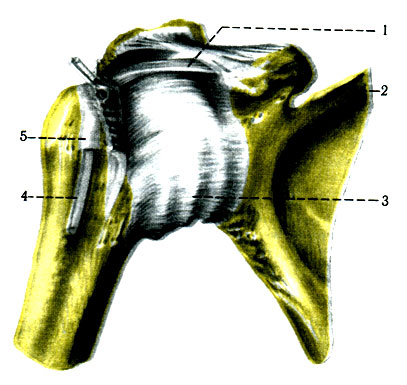 123. Плечевой сустав правый (по Р. Д. Синельникову). 1 - lig. coracohumerale; 2 - scapula; 3 - capsula articularis; 4 - tendo m. bicipitis brachii; 5 - vagina synovialis intertubercularis