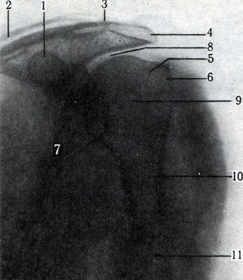 124. Рентгенограмма в задней проекции левого плечевого сустава. Пунктиром показано изменение угла между осью головки и диафиза плечевой кости (по Л. Д. Линденбратену). 1 - клювовидный отросток лопатки; 2 - ключица; 3 - ключично-акроминальное сочленение; 4 - акромион; 5 - анатомическая шейка плечевой кости; 6 - большой бугорок плечевой кости; 7 - лопатка; 8 - суставная впадина лопатки; 9 - головка плечевой кости; 10 - хирургическая шейка плечевой кости; 11 - диафиз плечевой кости