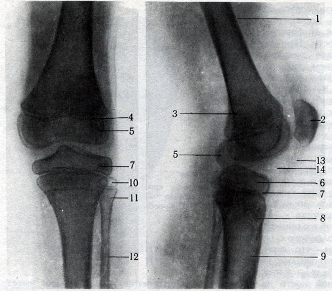149. Задний (а) и боковой (б) снимки коленного сустава. 1 - диафиз бедренной кости; 2 - надколенник; 3 - метафиз; 4 - эпифизарный хрящ бедренной кости; 6 - эпифиз большеберцовой кости; 7 - эпифизарный (ростковый) хрящ большеберцовой кости; 8 - метафиз большеберцовой кости; 9 - диафиз большеберцовой кости; 10 - эпифиз малоберцовой кости; 11 - метафиз малоберцовой кости; 12 - диафиз малоберцовой кости; 13 - собственная связка надколенника; 14 - 'ромбовидное пространство' (за счет прослойки рыхлой соединительной ткани)