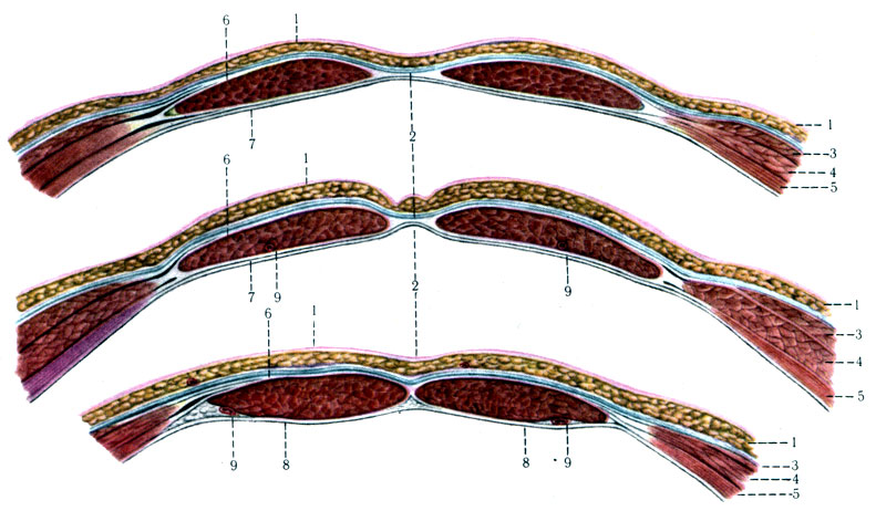 170. Поперечный разрез влагалища передней стенки живота на различных уровнях (схема). 1 - кожа с подкожной клетчаткой; 2 - linea alba; 3 - m. obliquus abdominis externus; 4 - m. obliquus abdominis internus; 5 - m. transbersus abdominis; 6 - vagina recti abdominis; 7 - vagina m. recti abdominis (задний листок); 8 - peritoneum et fascia transversalis; 9 - a. epigastrica inferior