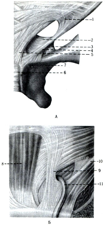 172. Поверхностное (А) и глубокое (Б) паховые кольца (схема). 1 - fibrae intercrurales; 2 - lig. reflexum; 3 - lig. lacunare; 4 - crus mediate; 5 - crus laterale; 6 - symphysis ossis pubis; 7 - r. supe rior ossis pubis; 8 - m. rectus abdominis; 9 - lig. interfoveolare; 10 - lig. inguinale; 11 - ductus defferens