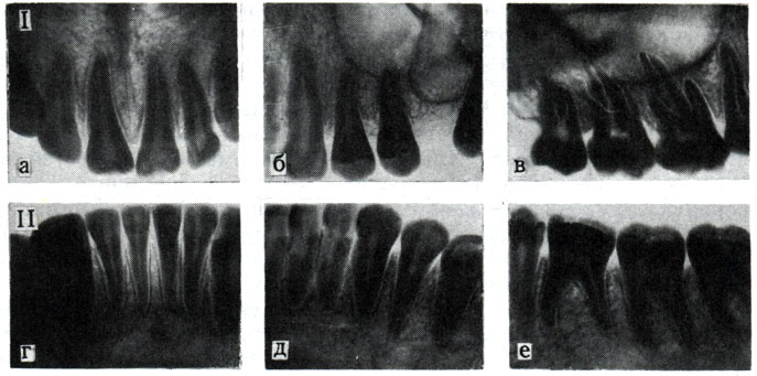 216. Рентгенограммы постоянных зубов. I - зубы верхней челюсти: а - резцы; б - клыки; и премоляры; в - моляры; II - зубы нижней челюсти: г - резцы; д - клыки и премоляры; е - моляры