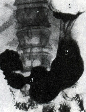232. Обзорная рентгенограмма желудка и двенадцатиперстной кишки. Желудок в форме крючка. 1 - свод желудка; 2 - тело; 3 - пилорическая часть
