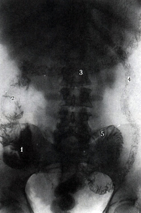 259. Обзорная рентгенограмма рельефа внутренней поверхности толстой кишки. 1 - слепая кишка; 2 - восходящая кишка; 3 - поперечная ободочная кишка; 4 - нисходящая кишка; 5 - сигмовидная кишка; 6 - прямая кишка