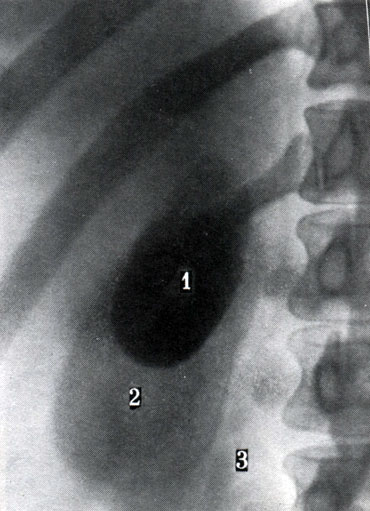 271. Обзорный передний снимок желчного пузыря при холецистографии. 1 - желчный пузырь; 2 - правая почка; 3 - наружный край большой поясничной мышцы