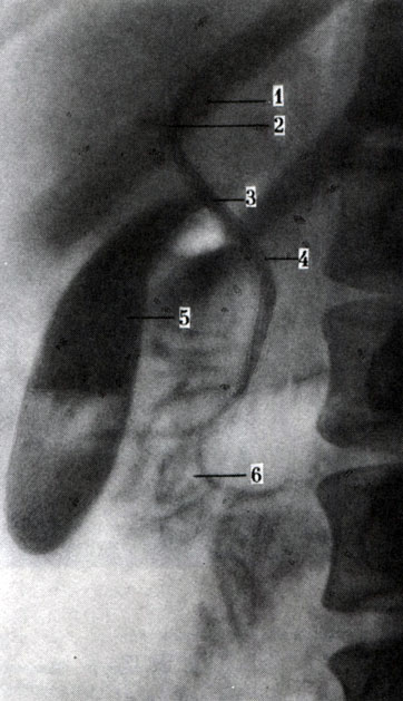 272. Обзорная рентгенограмма желчных путей при холеографии (по Л. Д. Линденбратену). 1 - левый печеночный проток; 2 - правый печеночный проток; 3 - печеночный проток; 4 - общий печеночный проток; 5 - желчный пузырь; 6 - контрастное вещество в нисходящей части двенадцатиперстной кишки