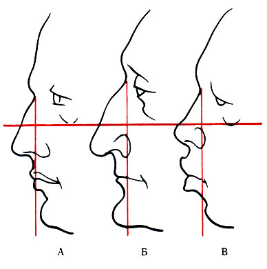 288. Индивидуальные особенности профилей носа и лица (по Topinard). А - прямой нос и умеренно выдающийся подбородок; Б - выпуклый нос и выдающийся подбородок; В - вогнутый нос и втянутый подбородок