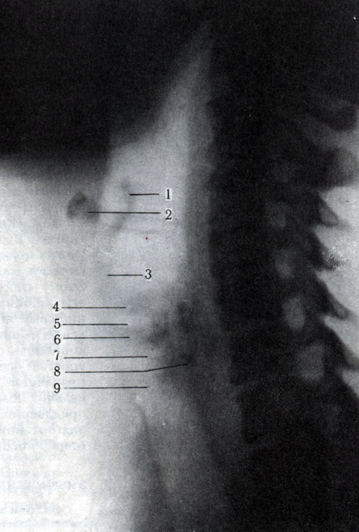 299. Левый боковой снимок гортани. 1 - надгортанник; 2 - подъязычная кость; 3 - щитовидный хрящ; 4 - связки преддверия; 5 - гортанный желудочек; 6 - голосовые связки; 7 - подсвязочное пространство; 8 - отложение извести в щитовидном хряще; 9 - перстневидный хрящ