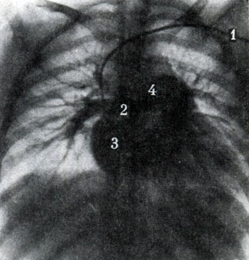 314. Артериальная фаза при общей ангиопульмонографии. Катетер (1) проведен до правого предсердия. Контрастированы правое предсердие (2), правый желудочек (3), легочная артерия (4) и ее ветви в обоих легких (по Л. Д. Линденбратену)