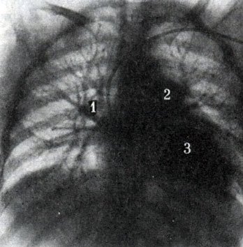 315. Венозная фаза при общей ангиопульмонографии (по Л. Д. Линденбратену). Катетер введен в правое предсердие. Контрастированы легочные вены (1), левое предсердие (2), левый желудочек (3). Контрастное вещество достигло восходящей аорты