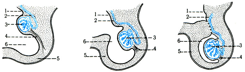 342. Процесс опускания яичка в мошонку. 1 - брюшина; 2 - семявыносящий проток; 3 - яичко; 4 - паховая связка; 5 - мошонка; 6 - processus vaginalis