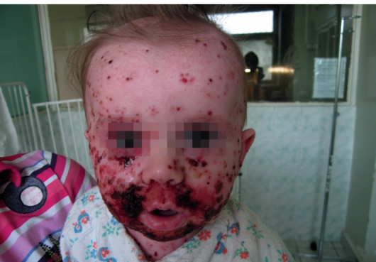 обострение дерматита у ребенка