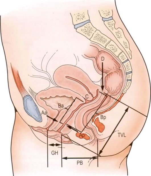 Опущение половых органов у женщин: профилактика, симптомы, диагностика и лечение