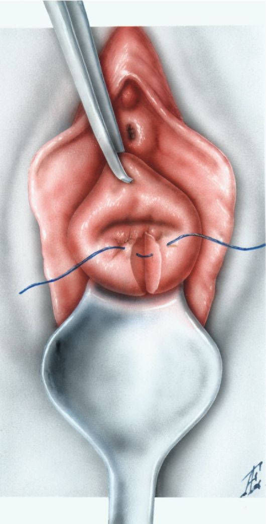 Пункция брюшной полости через задний свод влагалища в Иркутске в клинике Виктория