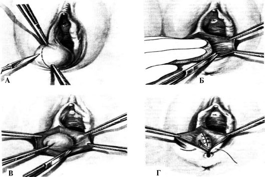 Женское обрезание (15 фотографий)