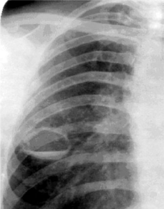 Туберкулез у ребенка: полное описание, симптомы и причины