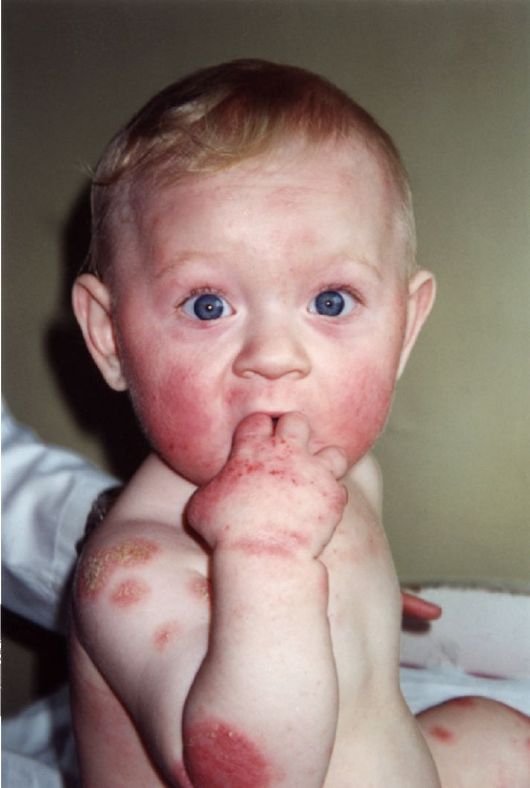 Геморрагическая болезнь новорождённых фото