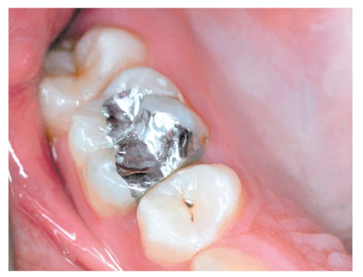 МАТЕРИАЛЫ, ИСПОЛЬЗУЕМЫЕ ДЛЯ ПЛОМБИРОВАНИЯ ПОЛОСТЕЙ II КЛАССА