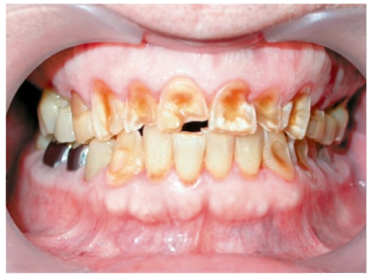 Некариозные повреждения зубов